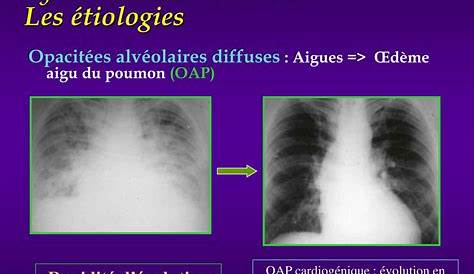 Syndrome De Condensation Pulmonaire Non Retractile