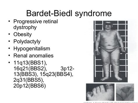 syndrome de bardet biedl