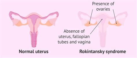 Rokitansky Syndrome: Unveiling the Rare and Mysterious Condition
