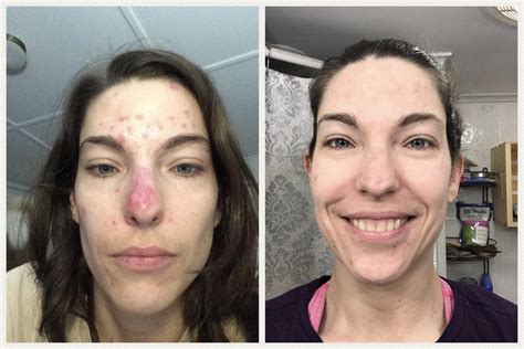 Systemic Lupus Weight Gain