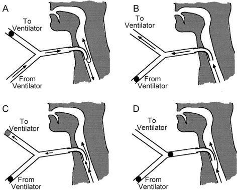t-piece vs trach collar