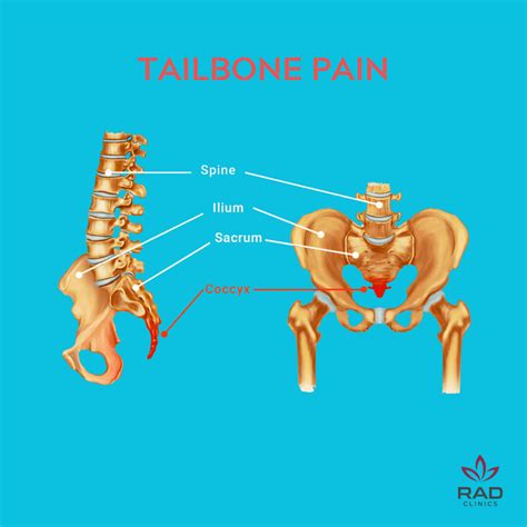 スノボ 尾てい骨 痛い