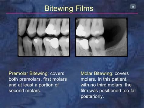 Taking Bitewing Radiography Technique