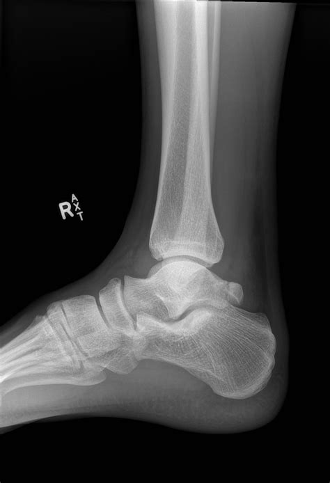 Talus Bone Fracture Nhs