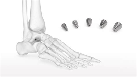 Talus Bone Screws