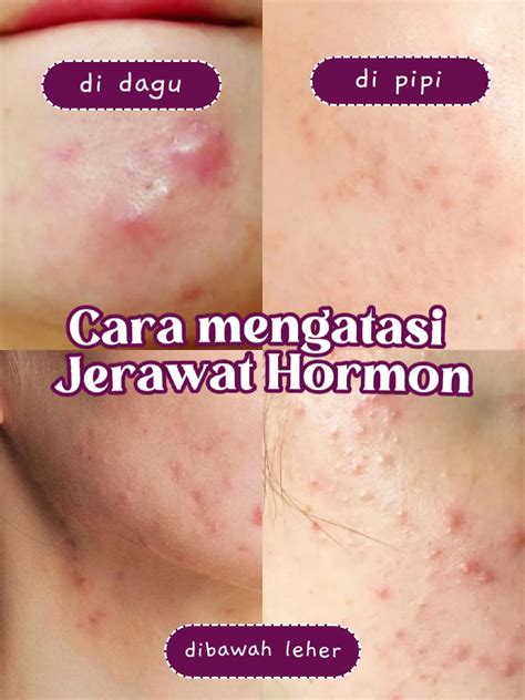 tanda jerawat hormon