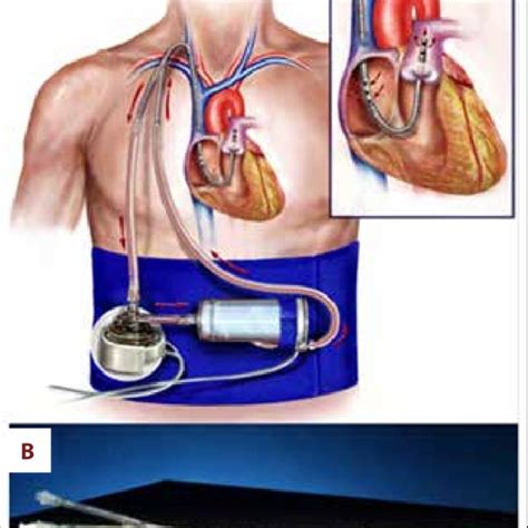 tandemheart rvad