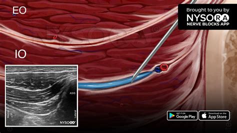 TAP BLOCK NYSORA’s 3D Anatomy videos YouTube