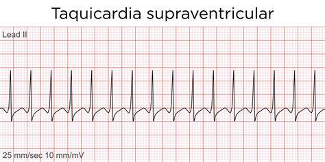 taquicardia supraventricular pediatria pdf