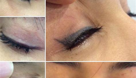 Tattoo Eyeliner Removal Near Me What You Should Know About The New