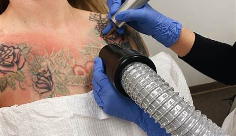 Tattoo Removal 1st Session Everything You Want To Know About Procedure