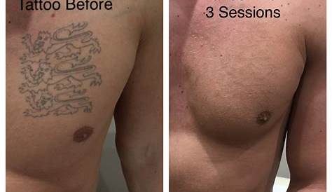 Tattoo Removal After 5 Sessions Before & Pictures Maine Laser Clinic