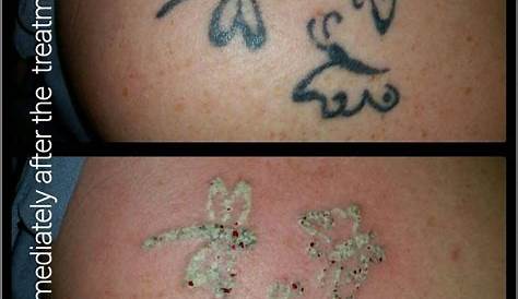 Tattoo Removal After First Session Treatment Treatment