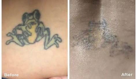 Tattoo Removal Baton Rouge La Bye Don Stevens LA Maple Leaf