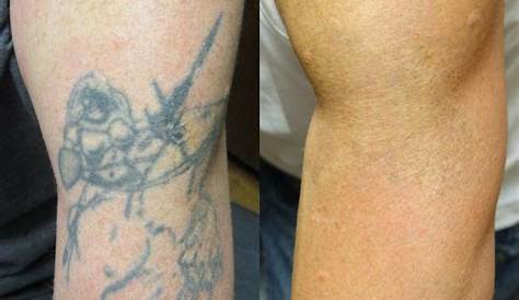 Tattoo Removal Before An After Laser Virginia Beach David H McDaniel MD