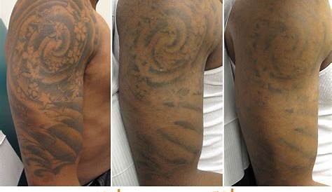 Tattoo Removal Before And After Black Skin Update More Than 73 Tone