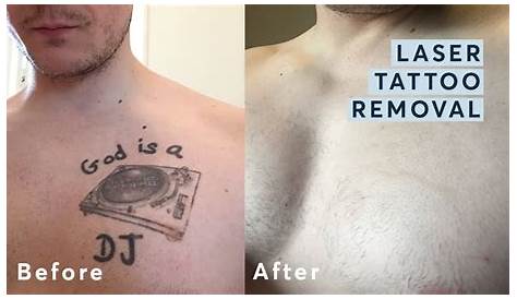 Tattoo Removal Before And After Chest s — Tailored Melbourne