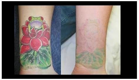 Tattoo Removal Before And After Color Laser No Results
