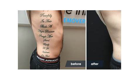 Tattoo Removal Before And After Healing Laser In Chicago IL Advanced Dermatology