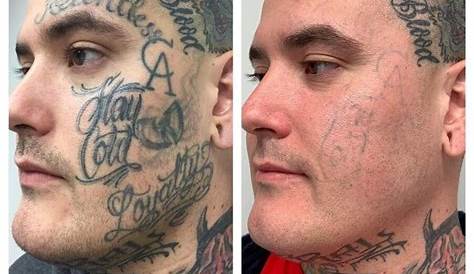 Tattoo Removal Before And After On Face Services Removery