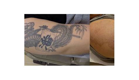 Tattoo Removal Before And After Picosure Laser Using PicoSure LaserYou PicoSure