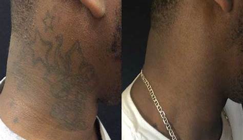 Tattoo Removal Black Skin Before After For Exgang Members Mark Laser Cost