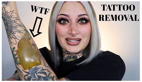Tattoo Removal Blisters Reddit Laser Brisbane Injex Clinics