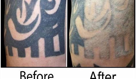 Tattoo Removal Brampton Cost Sovereign Shop