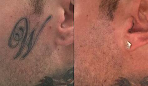 Tattoo Removal Brisbane Laser Clinic Lazco