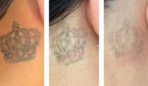 Canberra tattoo removal business booming thanks to 'ragrets' and