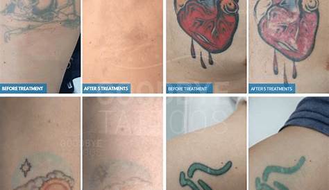 Tattoo Removal Color Tattoo Laser No Results