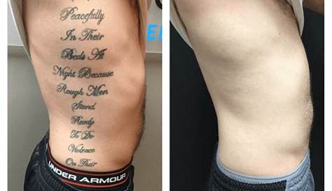 Tattoo Removal Cost Atlanta And Size Guide Removery