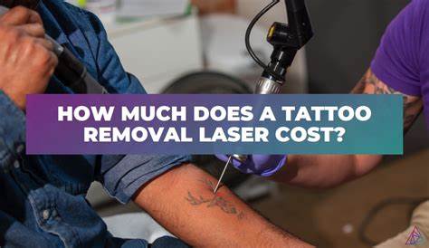 Tattoo Removal Cost Examples 7 Factors That Determine The Of Your Cares