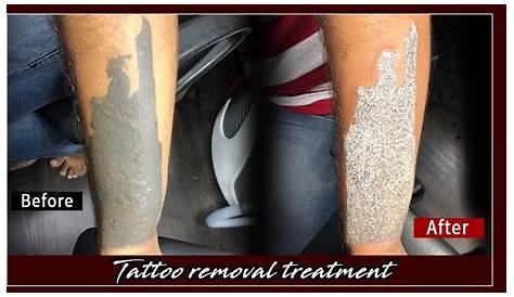 Tattoo Removal Cost In Mumbai Treatment By tattoo Removel dia