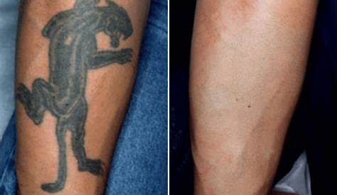 Tattoo Removal Cost Laser Away Will A Burn Ruin My New ?