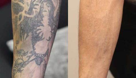 Tattoo Removal Cost Sleeve The Of In 2023 Bore Dodo