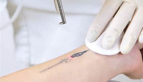 Tattoo Removal Course Canada Artists In Toronto Best Design Idea