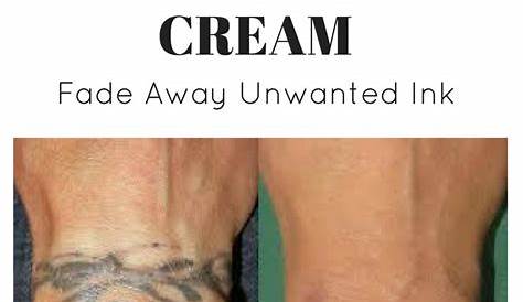 Tattoo Removal Cream Clinical Trials