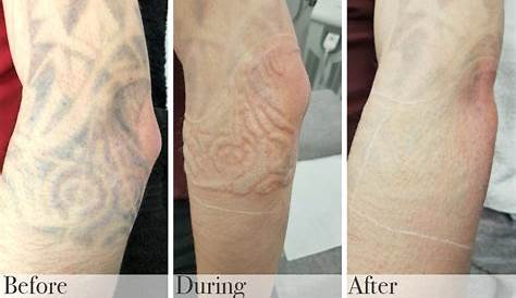 Tattoo Removal Doctor Near Me Timeless Allure