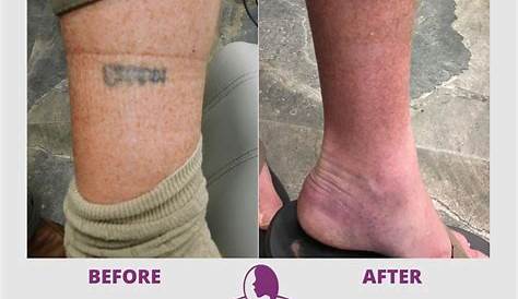 Tattoo Removal Does It Scar What To Know About Using s To