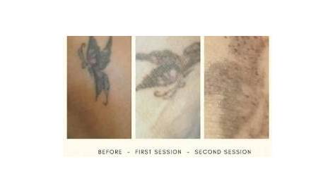Tattoo Removal Durban Price By Ashley Welman From TRADE MARK TATTOO South