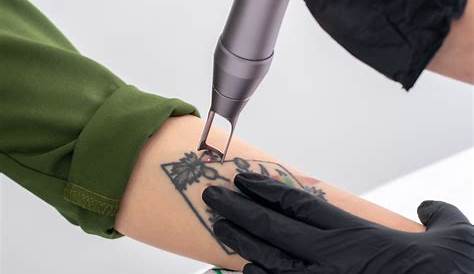 Tattoo Removal Edmonton Laser Albany Cosmetic And Laser Centre