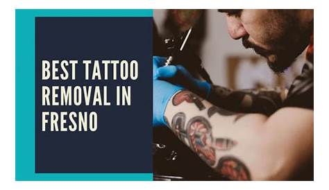 Tattoo Removal Fresno California Price Albertvandenbergh