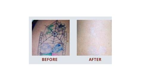 Tattoo Removal Glasgow Before After PicoSure