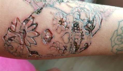Tattoo Removal Gone Bad I Found This Site That Offers A Natural