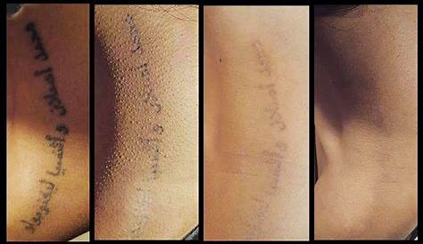 Tattoo Removal Greece Reviews Sovereign Shop