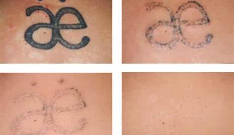 Tattoo Removal Healing Stages The Laser Process Removery