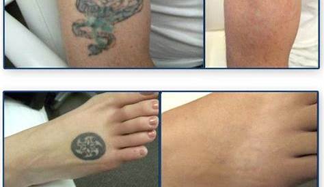 Tattoo Removal How Effective Treatment Treatment