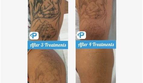 Tattoo Removal In Bossier City La 29+ Shops FlorenceMuaad