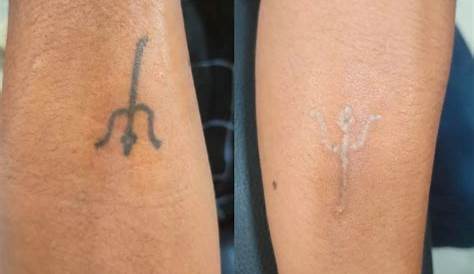 Best Laser Tattoo Removal in Kolkata Lizard's Skin Tattoos